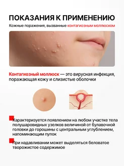 Раствор от контагиозного моллюска, 5 мл Стопмоллюск. Вид 2.