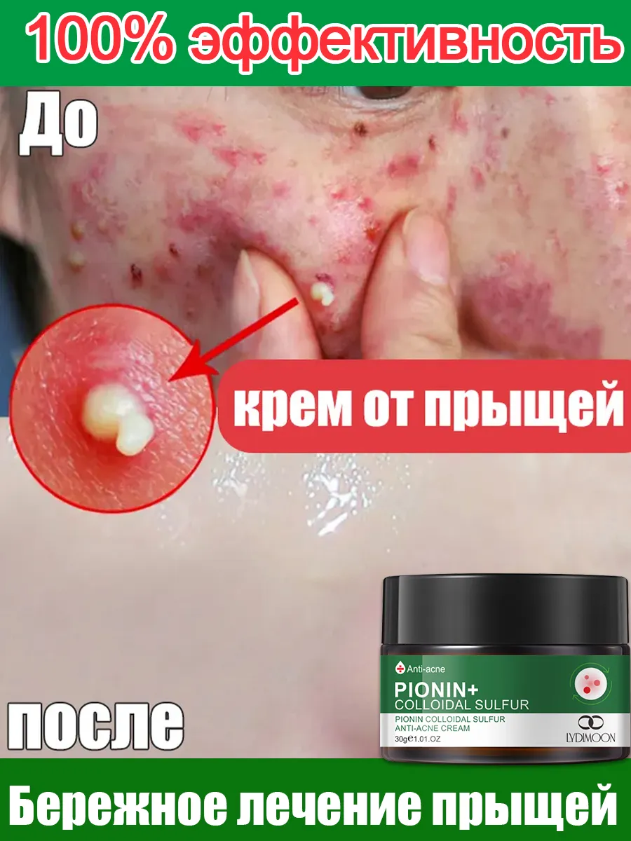 Крем для лица от прыщей с салициловой кислотой 30 г